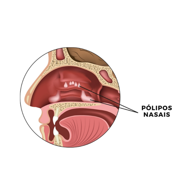 Pólipos Nasais: entenda o que é, causas e tratamentos